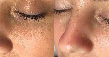 Threadlift treatment